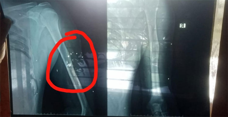 শরীরে ২২ ছররা গুলি নিয়ে জীবন কাটাচ্ছেন জুলাই যোদ্ধা আলাউদ্দিন