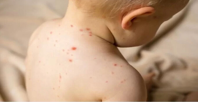 হাম থেকে বাঁচতে ভিড় এড়িয়ে চলবে হবে