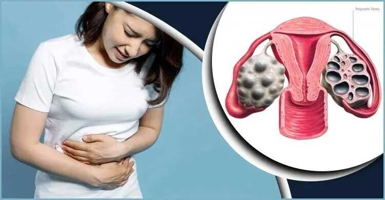 রোজায় কিশোরী পিসিওএস রোগীদের যেসব পরামর্শ দেন চিকিৎসক