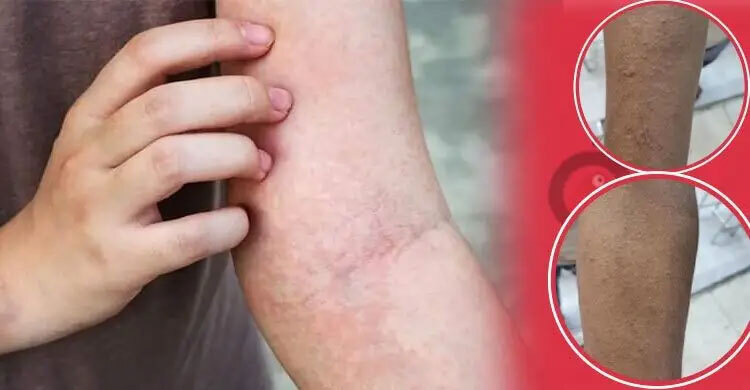 Allergy spike linked to pollution, doctors deny vaccine role