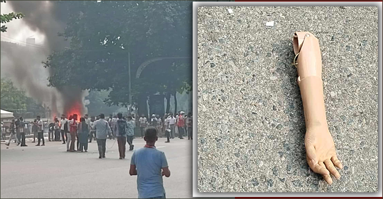 পুলিশের সঙ্গে সংঘর্ষ, রাস্তায় পড়েছিল জুলাই যোদ্ধার কৃত্রিম হাত