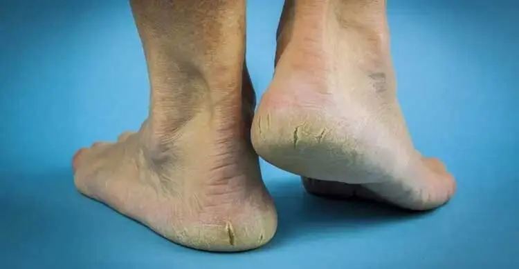 গরমেও পায়ের গোড়ালি ফাটছে, জানুন করণীয়