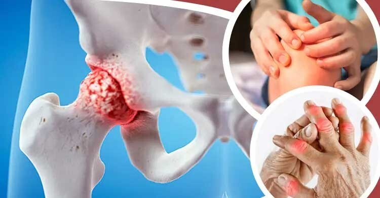 আর্থ্রাইটিস নিয়ন্ত্রণে জরুরি নিয়মিত যত্ন