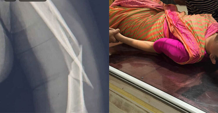 মাঝ আকাশে ঝাঁকুনির কবলে বিমানের ফ্লাইট, হাত ভাঙলো ক্রুর