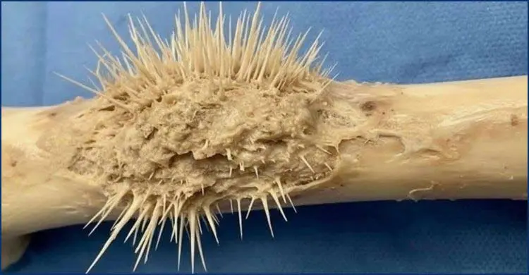 ছবি দেখে এআই মনে হলেও ‘সানরে প্যাটার্ন’ হাড়ের এক ভয়ংকর ক্যানসার