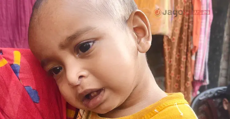 ঘরে ঘরে উপসর্গ নিয়ে ঘুরছে শিশুরা, উদাসীনতায় বাড়ছে হাম