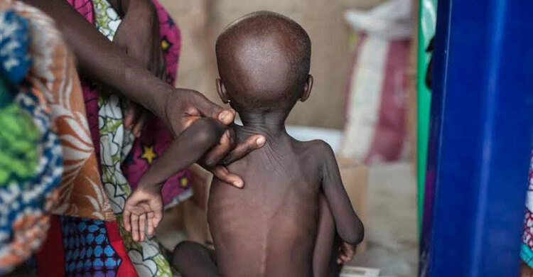 নাইজেরিয়ায় ছয় মাসে ৬৫২ শিশু অপুষ্টিতে মারা গেছে