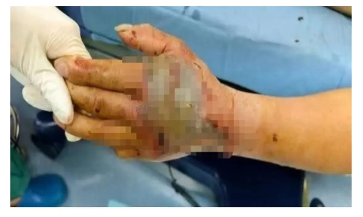 snake bite