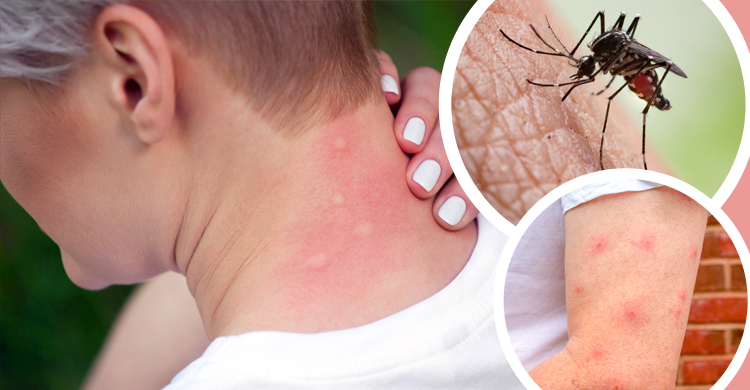 মশার কামড়ে চুলকানি? ঘরেই মিলবে সহজ সমাধান