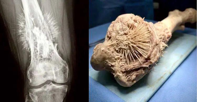 ছবি দেখে এআই মনে হলেও ‘সানরে প্যাটার্ন’ হাড়ের এক ভয়ংকর ক্যানসার