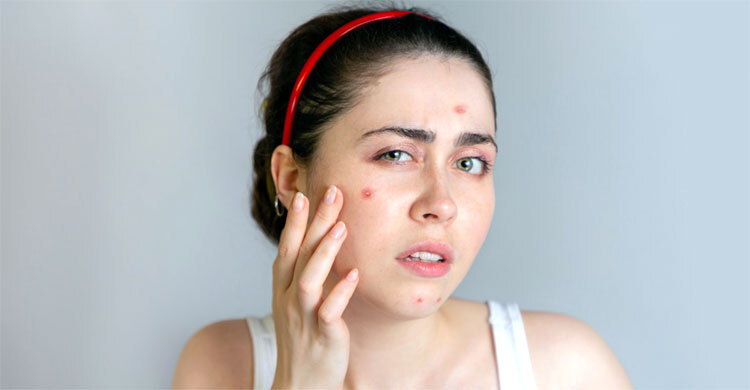 বর্ষায় ব্রণের সমস্যা দূর করবে ঘরোয়া ফেসপ্যাক