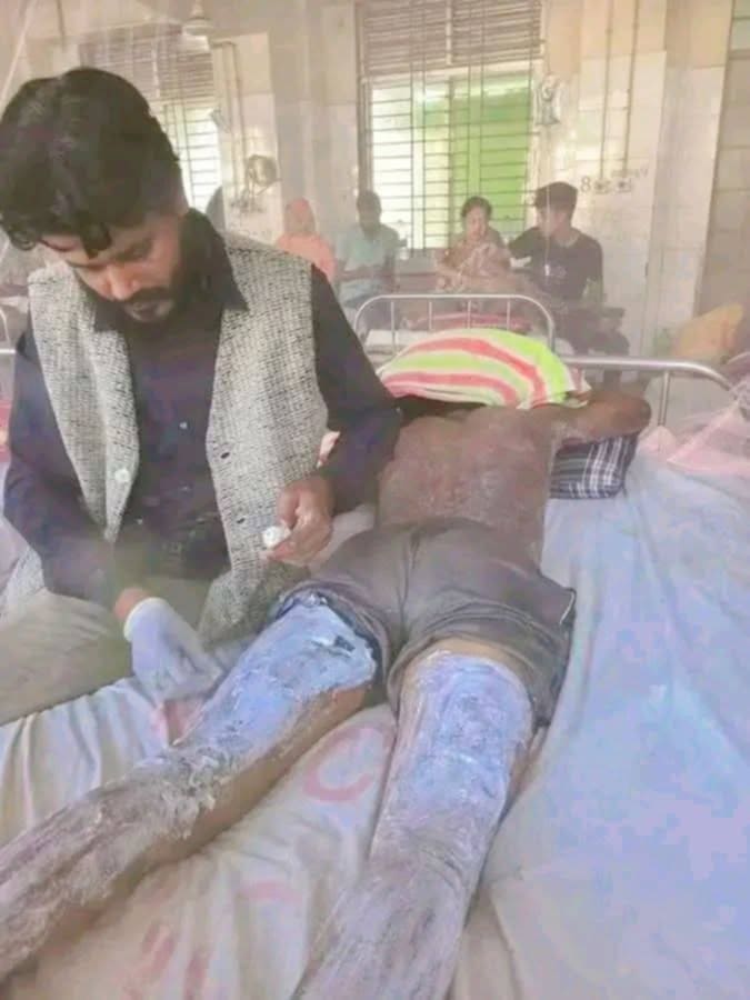 কনটেন্ট বানাতে গিয়ে অগ্নিদগ্ধ আল-আমিন বার্ন ইউনিটে