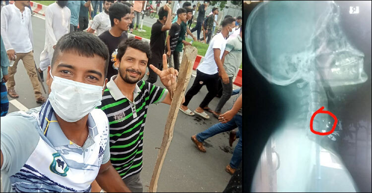 শরীরে ২২ ছররা গুলি নিয়ে জীবন কাটাচ্ছেন জুলাই যোদ্ধা আলাউদ্দিন