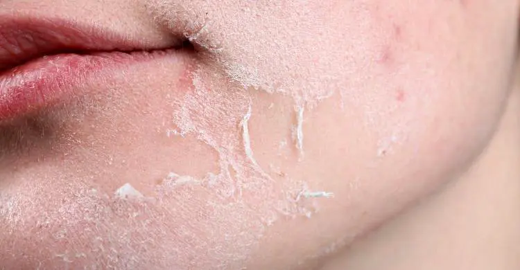 ডায়াবেটিস থাকলে ত্বক অতিরিক্ত শুষ্ক হয়ে যায় কেন