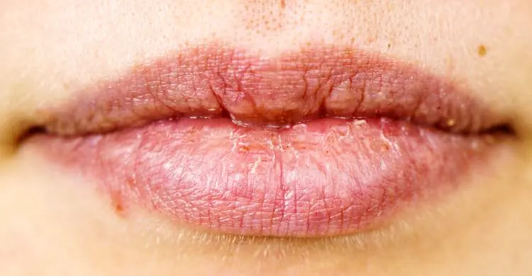 ডায়াবেটিস থাকলে ত্বক অতিরিক্ত শুষ্ক হয়ে যায় কেন