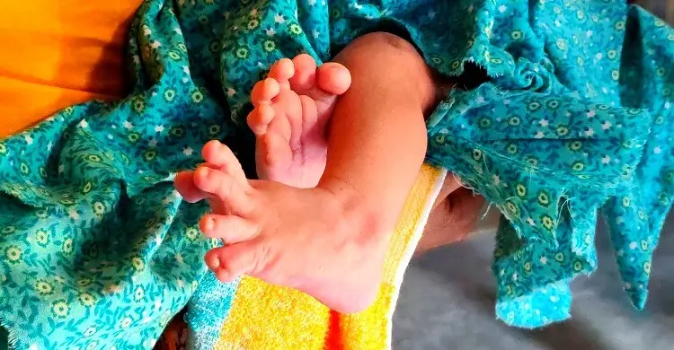 ২৮ আঙুল নিয়ে জন্ম নিলো শিশু