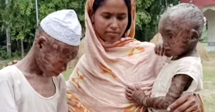 টাকার অভাবে চিকিৎসা বন্ধ বিরল রোগে আক্রান্ত ২ ভাইয়ের