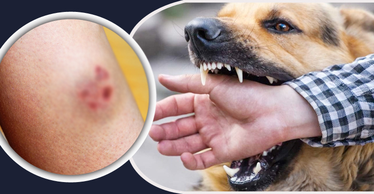 দু’দিনে কুকুর কামড়ালো ১২ জনকে, হাসপাতালে নেই ভ্যাকসিন