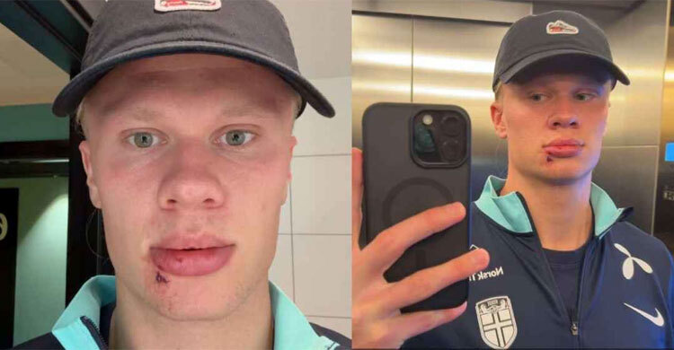 নরওয়ে দলে অদ্ভুত ঘটনায় আহত হালান্ড, সেলাই নিতে হলো মুখে