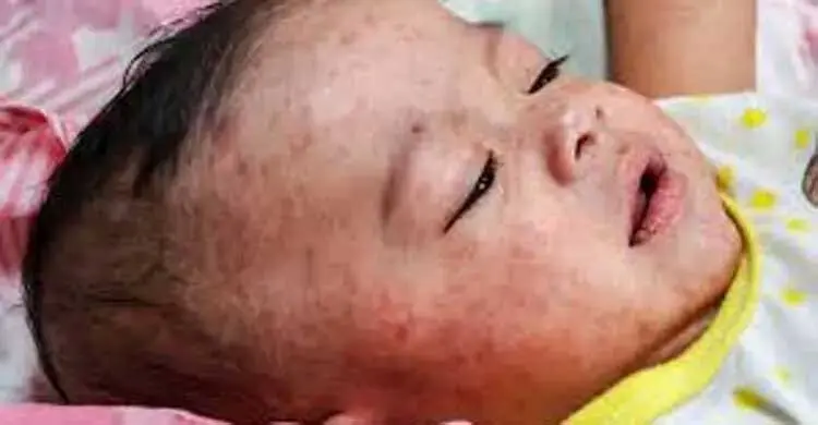 হাম হলে শিশুকে সুস্থ রাখতে মানুন এই নিয়ম