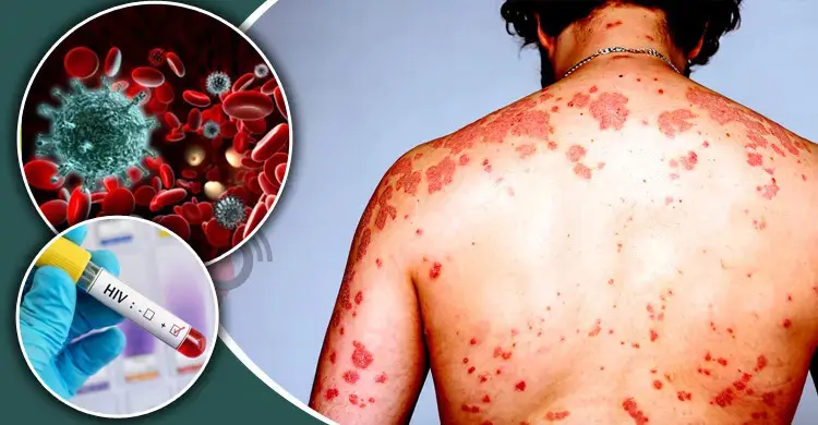 এইডস কেন হয়? জানুন ছড়ানোর কারণ ও করণীয় ৬টি উপায়