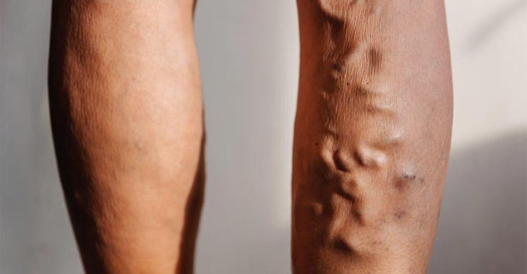 দীর্ঘক্ষণ দাঁড়িয়ে থাকলে হতে পারে ভ্যারিকোস ভেইনস