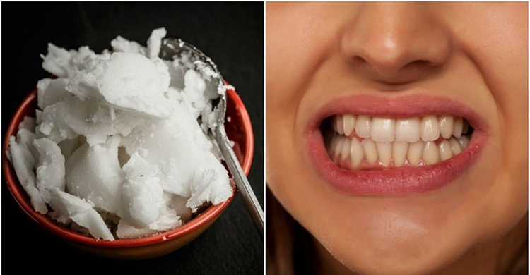 ঝকঝকে সাদা হাসি পাবেন দামি কোনো পণ্য ছাড়া!