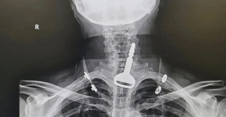 গলা থেকে বেরিয়ে এলো গাড়ির চাবি