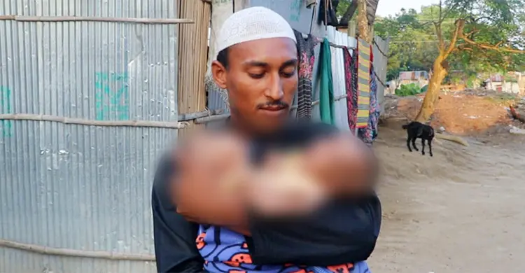 কুষ্টিয়ায় জোড়া লাগা সেই শিশু মারা গেছে