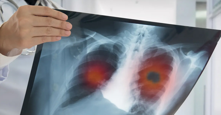 Lung cancer pill cuts risk of death by half, study finds