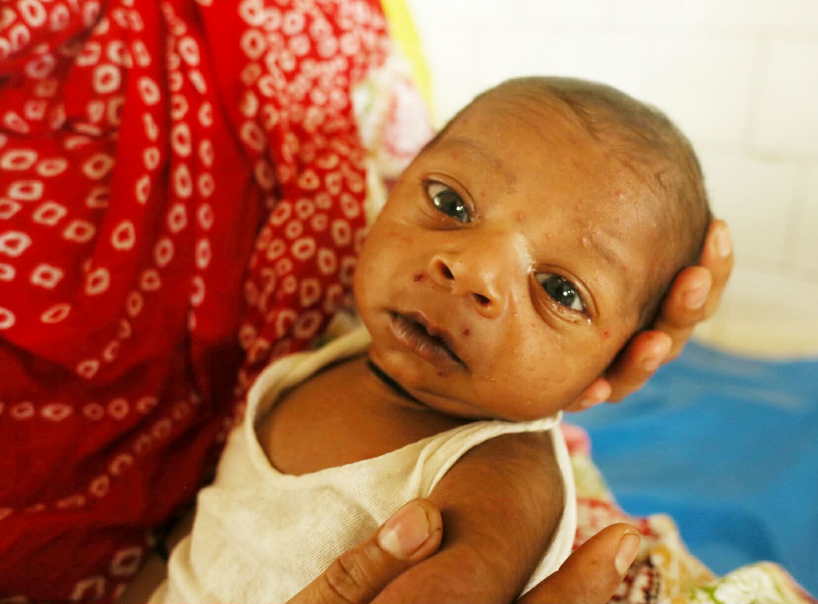 হাম নিয়ে আতঙ্ক নয়, সচেতনতা জরুরি