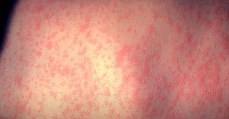 Measles outbreaks in Texas, New Mexico sicken nearly 100
