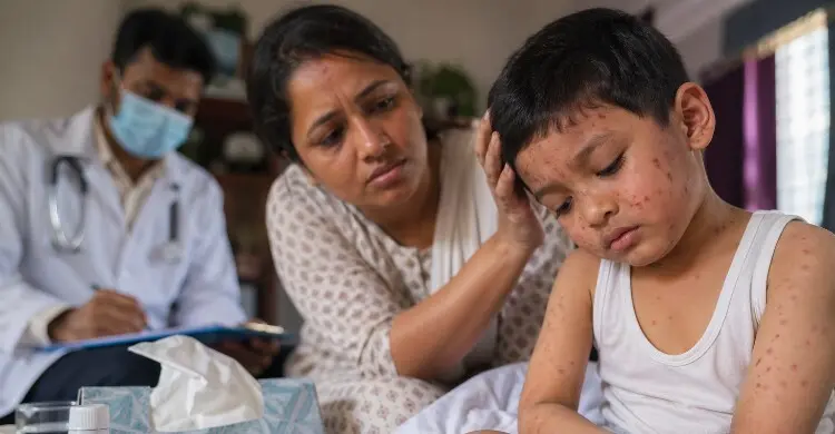হামের প্রাদুর্ভাব: শিশুদের মানসিক বিকাশে বাড়ছে ঝুঁকি