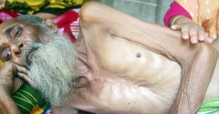 অ্যাপেন্ডিক্স অপারেশন করতে গিয়ে পায়ুপথের নালী কাটলেন চিকিৎসক