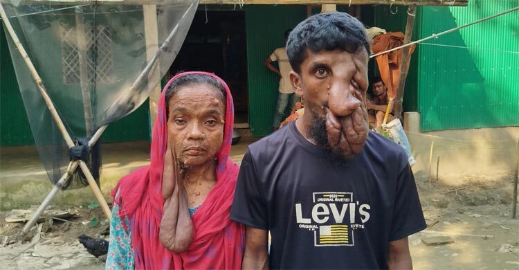 টিউমারে দুর্বিসহ হয়ে উঠেছে মা-ছেরে জীবন