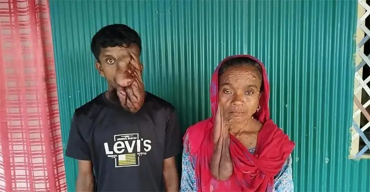 টিউমারে দুর্বিসহ হয়ে উঠেছে মা-ছেরে জীবন