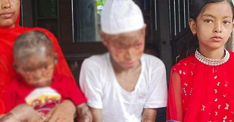 বিরল রোগে আক্রান্ত দুই ভাইয়ের দায়িত্ব নিলেন সাবেক সংসদ সদস্য