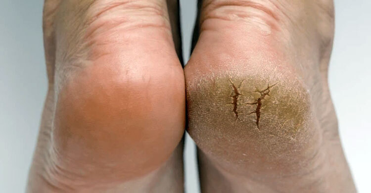 সারাবছর কেন পা ফাটে