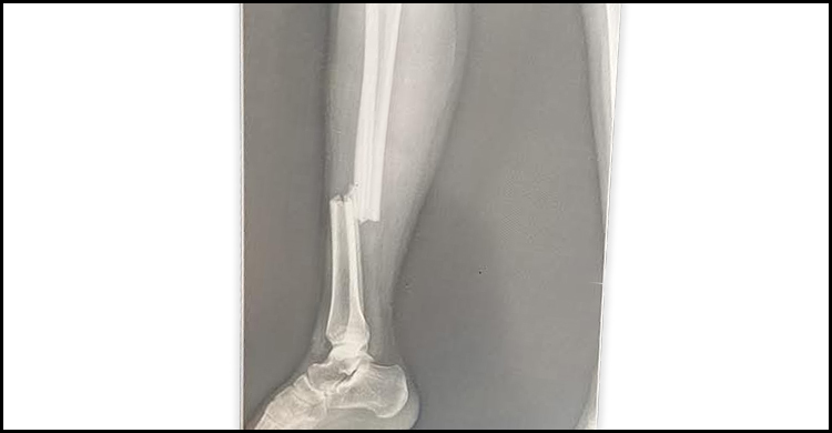 রাবিতে শিক্ষকের গাড়ির ধাক্কায় পা ভাঙলো ছাত্রীর