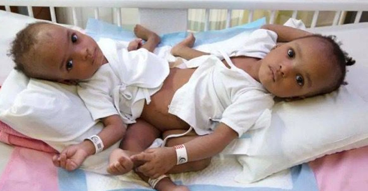 ১৪ ঘণ্টার অস্ত্রোপচারে আলাদা হলো জোড়ালাগা দুই শিশু
