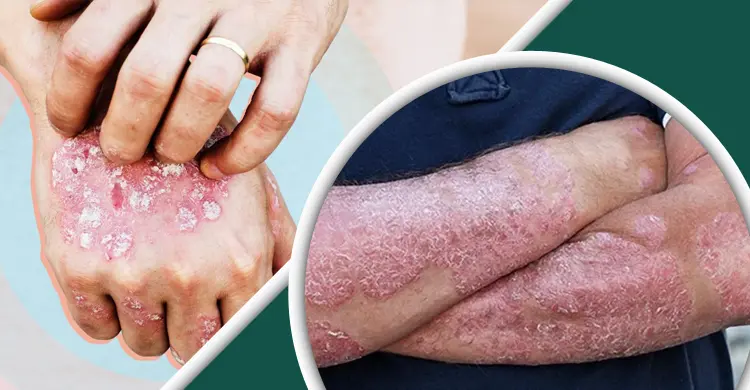 সোরিয়াসিসের চুলকানি ও যন্ত্রণা সারাতে যা ব্যবহার করবেন