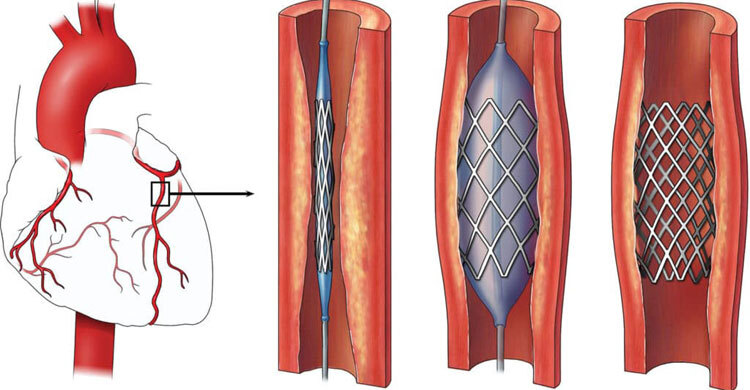 A lifesaving cut: Govt slashes coronary stent prices to ease patient burden