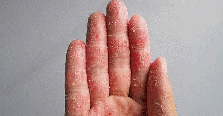 শীতে হাতের আঙুল ফাটা দূর করার ঘরোয়া উপায়