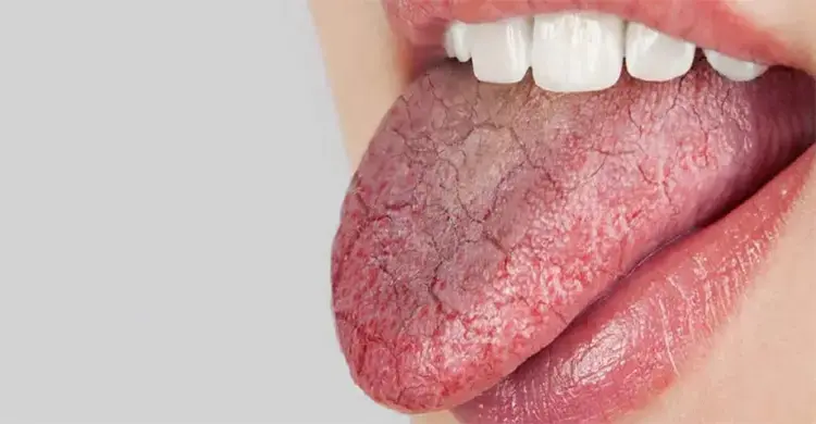 Sudden burning sensation on the tongue? Could it be a big sign?