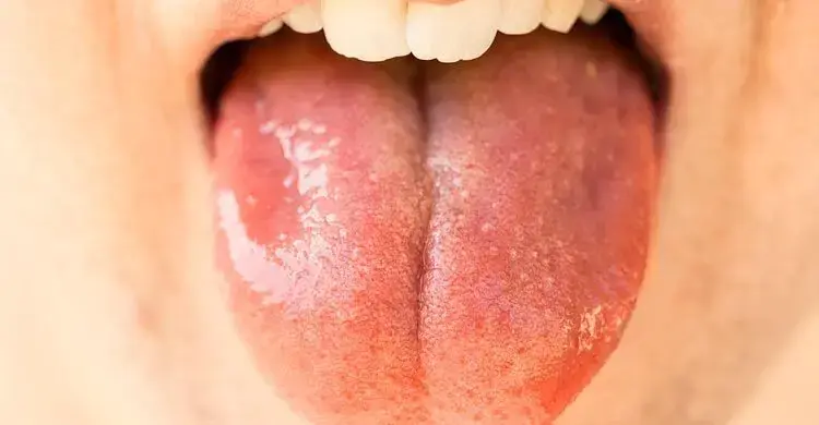 Sudden burning sensation on the tongue? Could it be a big sign?