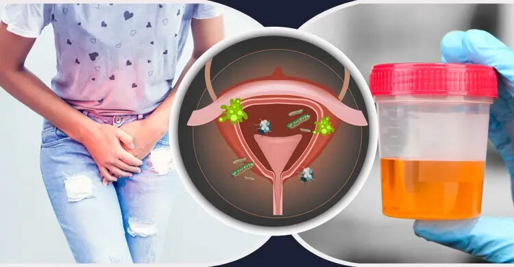 প্রস্রাবে ইনফেকশন সারানোর ঘরোয়া ৫ উপায়