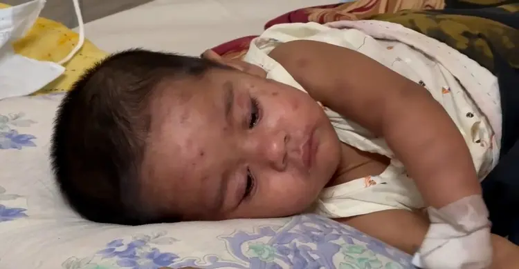 ঢাকাসহ সারাদেশে হামের বিস্ফোরণ! হাসপাতালগুলোতে উপচে পড়া ভিড়