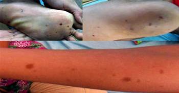 নওগাঁয় অর্ধশত শিক্ষার্থী অজানা রোগে আক্রান্ত