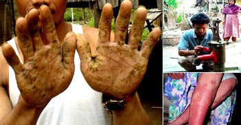 আর্সেনিকে ৭ বছরে ১৩ জনের মৃত্যু, আক্রান্ত ৫০০