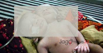 মায়ের কোলজুড়ে ২ মাথার শিশু